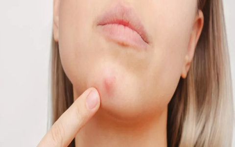 Fast & Effective: Quick Easy Ways to Get Rid of Pimples